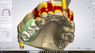 Cast Partial Denture Digital Design [upl. by Ethelyn]