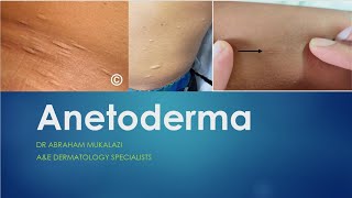 ANETODERMA BY DR ABRAHAM dermatology scarystory skincareeducation funny ANETODERMA [upl. by Assenat]