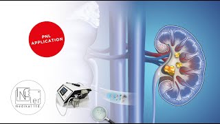 Percutaneous Nephrolithotomy PNL Application Lithobox Zero [upl. by Ingar]