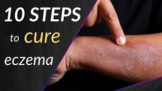 These 10 Steps Will Cure Your Eczema [upl. by Lledal]