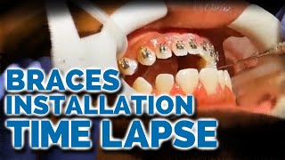 Braces Installation Time Lapse What to expect when getting braces [upl. by Onitsuaf]