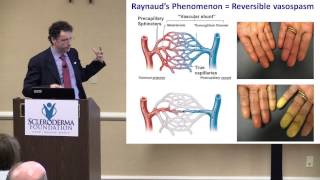 2015 Nashville The Scleroderma Hands and Their Care Dr Francesco Boin [upl. by Bronk]