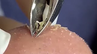 Deep Dive Blackhead Removal The Tweezer Method [upl. by Klos]