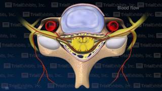 Arterial Vasospasm with Resulting Embolic Stroke [upl. by Basir]