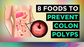 8 Foods To Prevent COLON POLYPS amp BOWEL CANCER [upl. by Barrie885]