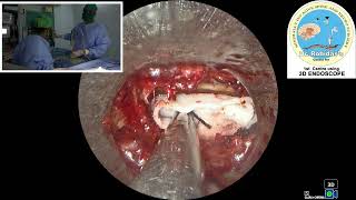 Rt L5S1 endo discectomy [upl. by Rheta265]