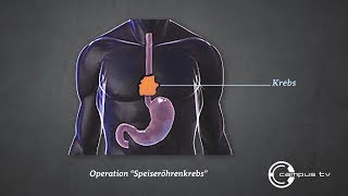 Speiseröhrenkrebs So wird ein Ösophaguskarzinom mit dem OPRoboter minimalinvasiv operiert [upl. by Ranip]