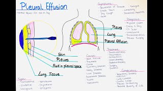 Understanding Pleural Effusion  Causes Symptoms Diagnosis Treatment Complications Types [upl. by Wolfe293]