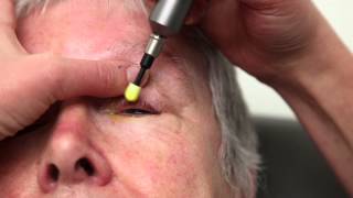 Blepharitis Treatment That Really Works Blephex Eyelid Cleaning [upl. by Tildie]