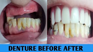 Removable denture before after [upl. by Mialliw600]