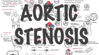 Aortic Stenosis  Overview signs and symptoms pathophysiology treatment [upl. by Inot804]