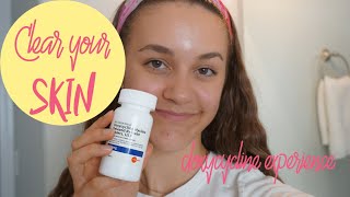 How To Get Rid of Acne  My Doxycycline Experience [upl. by Fotina]