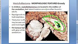 Pathology 897 a Medulloblastoma brain Homer Wright psuedorosettes Drop metastases child tumor cauda [upl. by Marienthal]