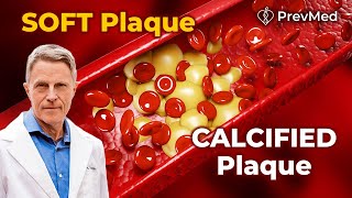 The Difference between Soft plaque and Calcified plaque [upl. by Enohpesrep442]