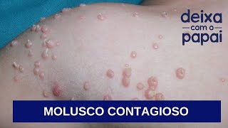 MOLUSCO CONTAGIOSO O QUE É COMO TRATAR QUAIS CUIDADOS DEVEMOS TER DEIXA COM O PAPAI [upl. by Moclam247]