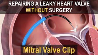 MITRACLIP Mitral Valve Clip  Repairing a Leaky Heart Valve without Surgery [upl. by Razid]