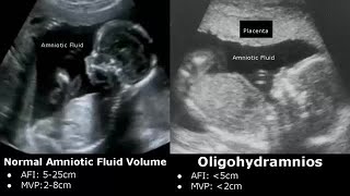 Obstetric Ultrasound Normal Vs Abnormal Images  Fetal Placenta Umbilical Cord Pathologies USG [upl. by Shermie739]