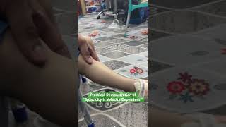 Spasticity is Velocity Dependent  Practical Demonstration [upl. by Daas17]