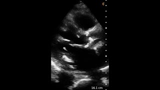 Aortic Stenosis – Ultrasound Image Interpretation [upl. by Elyc]