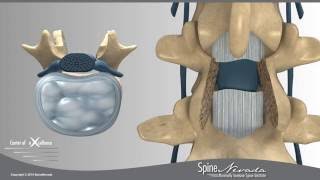 Lumbar Laminectomy and Fusion Presented by Swift Institute Reno Spine Surgeons and Spine Center [upl. by Rici]