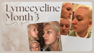 ACNE MONTH 3 ON LYMECYCLINE [upl. by Ahsitra]