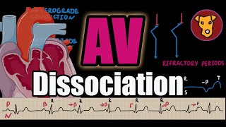 ATRIOVENTRICULAR AV DISSOCIATION Classification pathophysiology ECG CRITERIA examples [upl. by Ahseniuq]