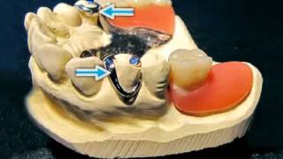 Ankerzahn bei Teilprothesen [upl. by Drucie237]