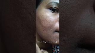 1 Month Using Tretinoin Daily to see the effect viralvideo tretinoin shorts youtubeshorts [upl. by Det]