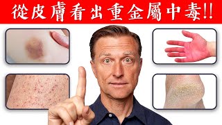 【皮膚】重金屬中毒症狀排出毒素自然療法柏格醫生 Dr Berg [upl. by Haily]