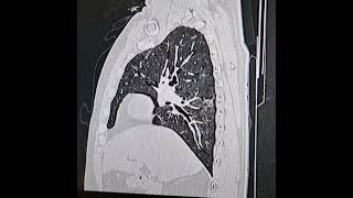 Desquamative interstitial pneumonia Coronal and sagittal images images [upl. by Eyar]