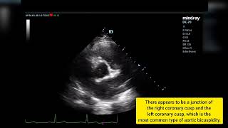 Válvula aórtica bicúspide Ecocardiograma tt  Bicuspid aortic valve on Transthoracic Echocardiogram [upl. by Ashely]