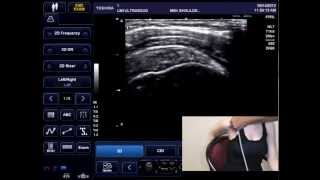 MSK Shoulder Ultrasound Exam  Supraspinatus Tendon [upl. by Annawahs236]