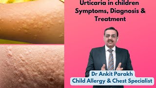 Urticaria in children Symptoms Diagnosis amp Treatment Dr Ankit Parakh Allergy Specialist [upl. by Magna]