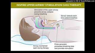 Hypoglossal nerve stimulation for obstructive sleep apnea [upl. by Vod]