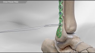 Distal Fibular Plate [upl. by Esirahc]