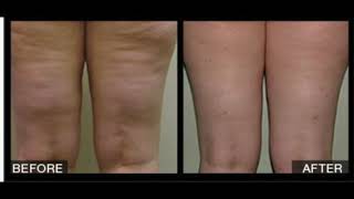 VelaShape Body Contouring [upl. by Nedaj]