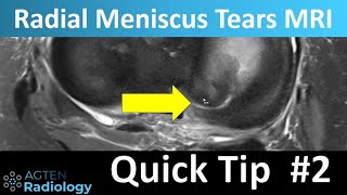 MSK Quick tip 2  Simple way to see radial meniscus tears [upl. by Nelleeus]