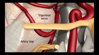 Treatment for Trigeminal Neuralgia UCSF Neurosurgery [upl. by Ocirema953]