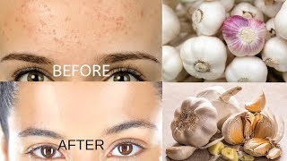 Remove Forehead Pimples Overnight  Acne Treatment with Garlic [upl. by Adest]