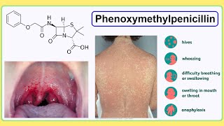 phenoxymethylpenicillin [upl. by Aicinad373]