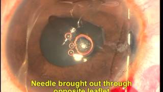 Siepser knot iridoplasty in phakic eye Soosan Jacob 22 min [upl. by Akihsay]