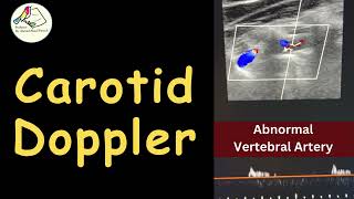 Carotid amp Vertebral Doppler  Carotid Atheroma Abnormal VA  Case story [upl. by Enawyd264]