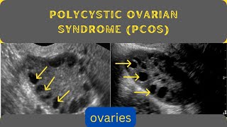 Enlarged Ovaries  Polycystic Ovarian syndrome PCOS  Ultrasound [upl. by Alul]