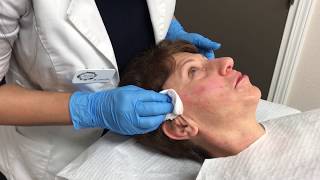 PDO Thread Lift  Non Surgical Better Than Botox  Revivify Medical Spa Beaumont TX [upl. by Nayhr]