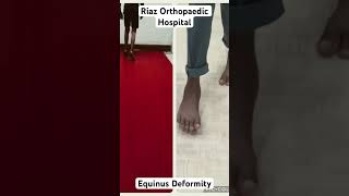 BL Equinus Deformity Foot [upl. by Etat]