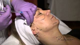 Dr Berne Harmony Program Oslo Restylane Tear Trough and Cheeks [upl. by Jorge]