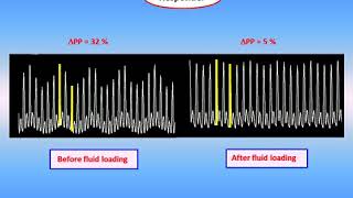 PRACTICAL USE OF HEART LUNG INTERACTIONS TO ASSESS HAEMODYNAMIC STATUS Teboul JL 2015 [upl. by Sibel268]