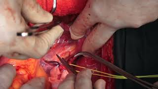 Concomitant AortoCaval Resection with Aortoiliac reconstruction for Retroperitoneal Sarcoma [upl. by Pen]