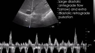 CASE 711 Congestive hepatopathy Chronic passive congestion [upl. by Zoi]