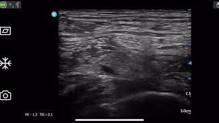 Femoral nerve block by Vscan Air [upl. by Gerrie954]